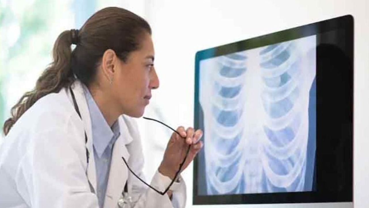 ফুসফুস ক্যানসার শনাক্তে এআই