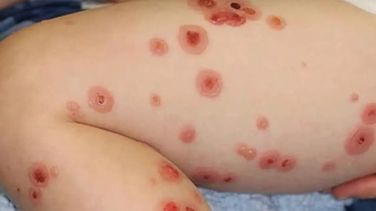 যুক্তরাজ্যে মেনিনজাইটিস আতঙ্ক: থাইল্যান্ডসহ বিভিন্ন দেশে সতর্কতা জারি