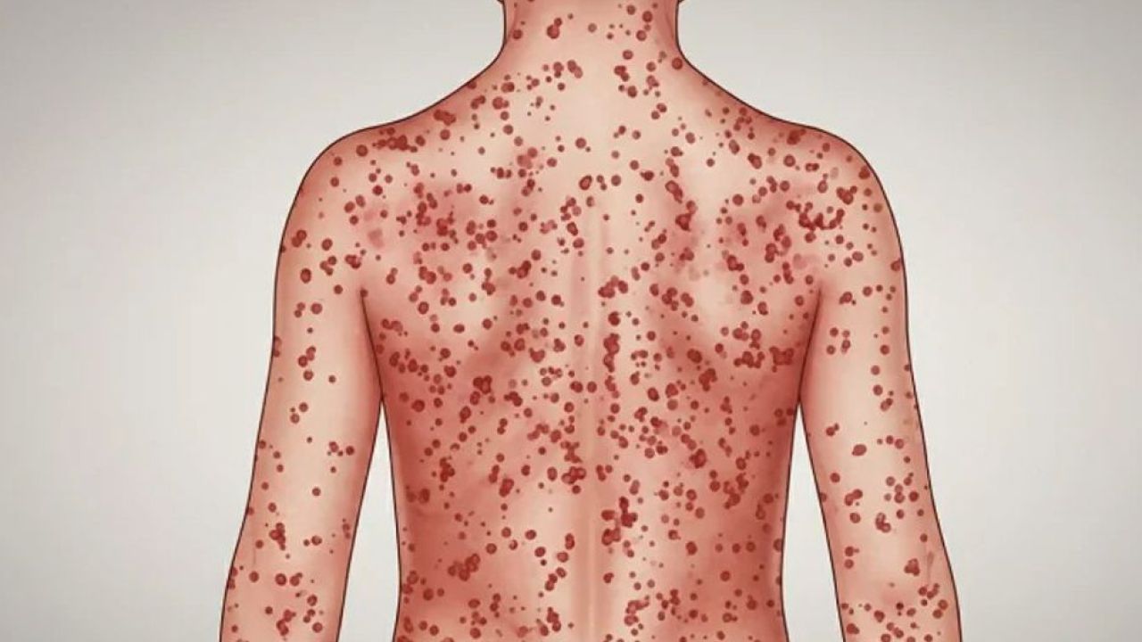 ২০ জেলার ৩০ এলাকাকে হামের ‘হটস্পট’ ঘোষণা ও জরুরি টিকাদান শুরু