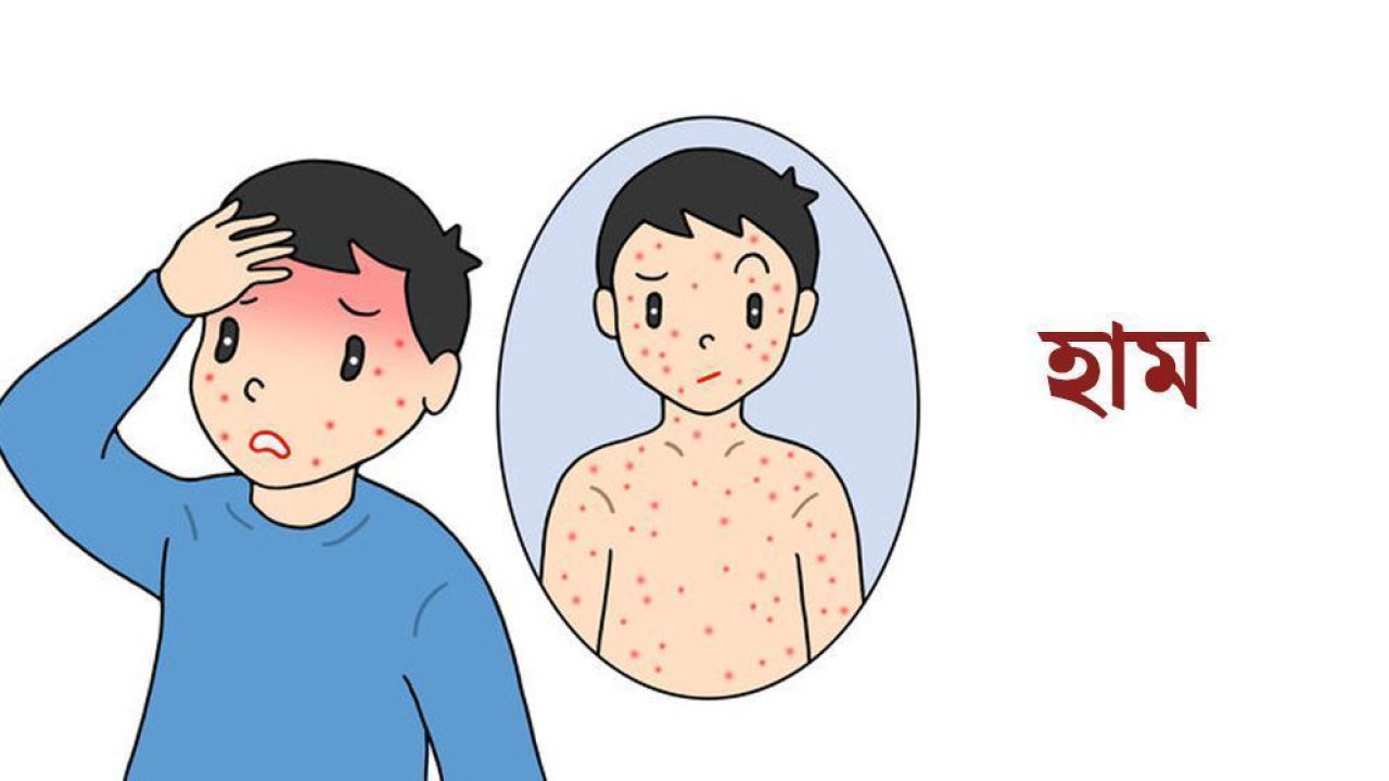 কুমিল্লায় হামে আক্রান্ত শিশুর মৃত্যু, আতঙ্ক বাড়ছে